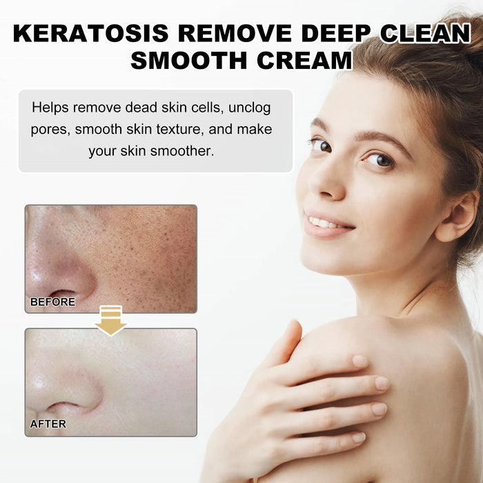 Crème nettoyante hydratante pour peau acnéique, élimine le cutin et resserre les pores, texture douce et fluide.